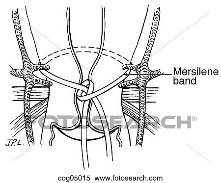 Stock Illustration - Cervical cerclage, transabdominal. Fotosearch
