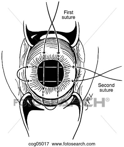 Stock Illustration - Cervical cerclage, Wurm procedure. Fotosearch
