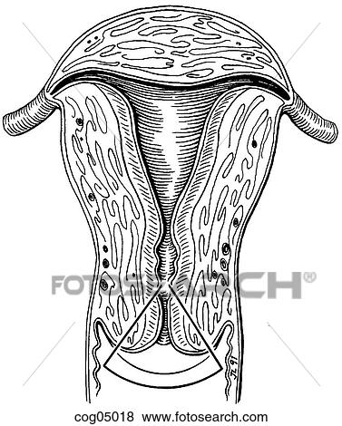 Cervical conization, cold knife technique View Large Illustration Stock Illustration - Cervical conization, cold knife technique. Fotosearch