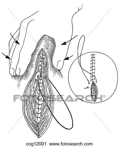 Cesarean delivery, closure View Large Illustration Clip Art - Cesarean delivery, closure. Fotosearch