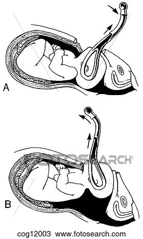 Drawing - Cesarean delivery, forceps. Fotosearch
