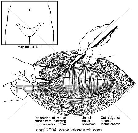 Cesarean delivery, Maylard incision View Large Illustration Stock Illustration - Cesarean delivery, Maylard incision. Fotosearch