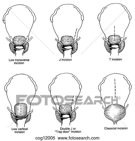 Cesarean delivery, myometrial incisions View Large Illustration Stock Illustration - Cesarean delivery, myometrial incisions. Fotosearch