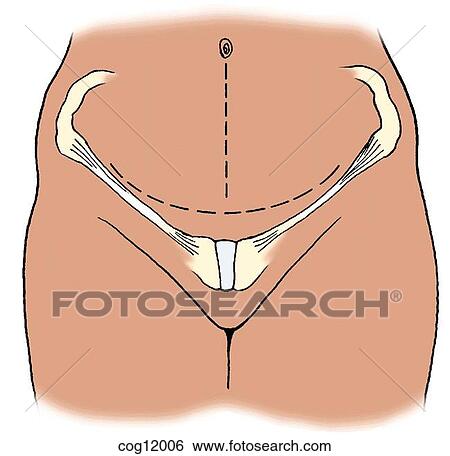 Cesarean delivery, surgical incisions View Large Illustration Stock Illustration - Cesarean delivery, surgical incisions. Fotosearch