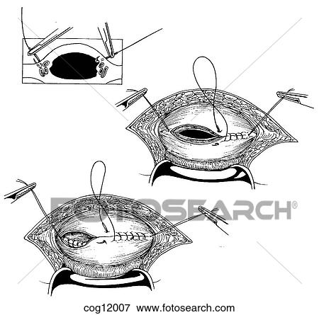 Cesarean delivery, two-layer closure View Large Illustration Stock Illustration - Cesarean delivery, two-layer closure. Fotosearch