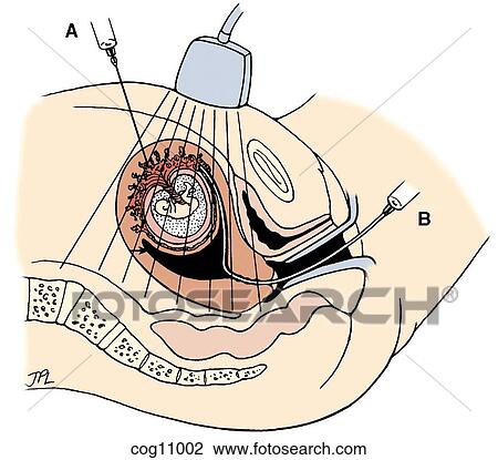 clip art of chorionic villus sampling ultrasound guided chorionic villus sampling