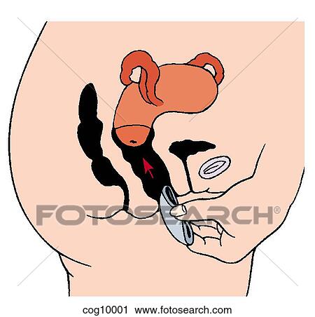 Diaphragm, insertion technique, step 1 View Large Illustration Clip Art - Diaphragm, insertion technique, step 1. Fotosearch