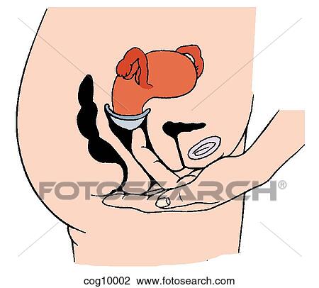 Diaphragm, insertion technique, step 2 View Large Illustration Drawing - Diaphragm, insertion technique, step 2. Fotosearch