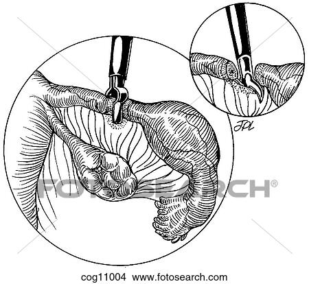 Stock Illustration - Ectopic pregnancy, resection, techn. 1, step 1. Fotosearch