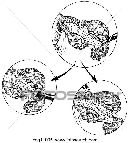 Stock Illustration - Ectopic pregnancy, resection, techn. 1, step 2. Fotosearch