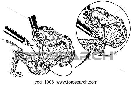 Stock Illustration - Ectopic pregnancy, resection, techn. 2, alt. step. Fotosearch