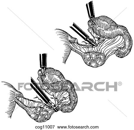 Ectopic pregnancy, resection, techn. 2, alt. step View Large Illustration Stock Illustration - Ectopic pregnancy, resection, techn. 2, alt. step. Fotosearch