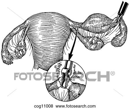 Ectopic pregnancy, resection, techn. 2, step 1 View Large Illustration Stock Illustration - Ectopic pregnancy, resection, techn. 2, step 1. Fotosearch