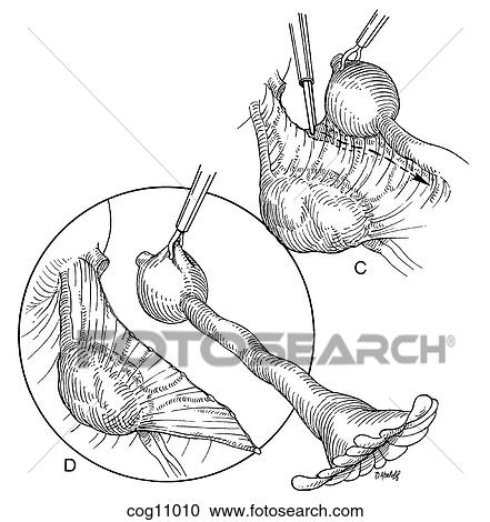 Clipart - Ectopic pregnancy, resection, techn. 3, step 2. Fotosearch