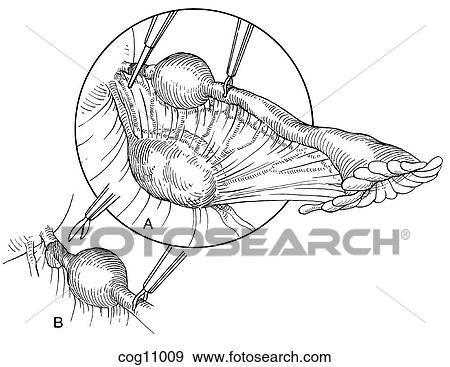 Stock Illustration - Ectopic pregnancy, resection, techn. 3, step 1. Fotosearch