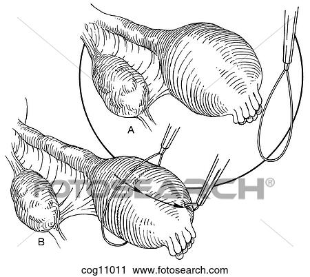 Ectopic pregnancy, resection, techn. 4, step 1 View Large Illustration Clip Art - Ectopic pregnancy, resection, techn. 4, step 1. Fotosearch