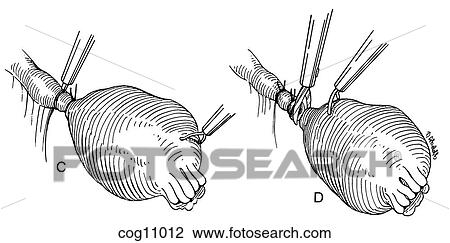 Ectopic pregnancy, resection, techn. 4, step 2 View Large Illustration Drawing - Ectopic pregnancy, resection, techn. 4, step 2. Fotosearch