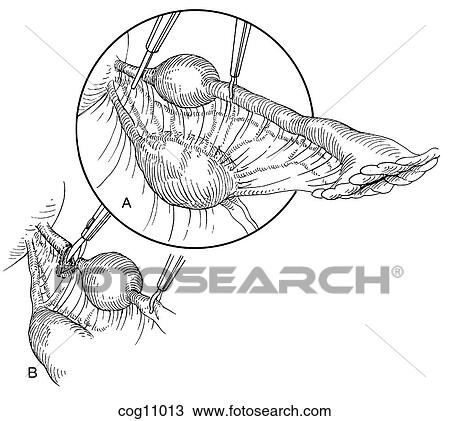 Drawing - Ectopic pregnancy, resection, techn. 5, step 1. Fotosearch
