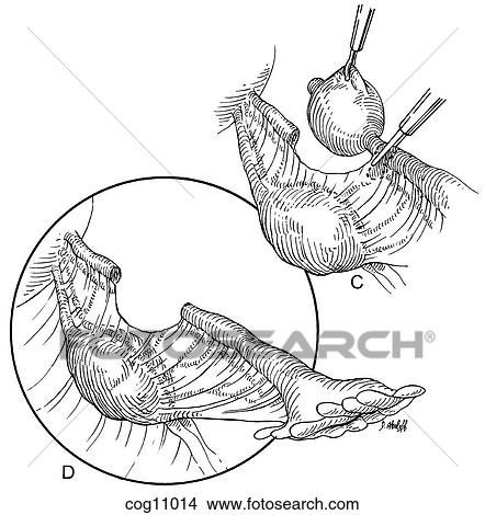 Stock Illustration - Ectopic pregnancy, resection, techn. 5, step 2. Fotosearch