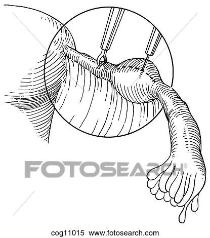 Stock Illustration - Ectopic pregnancy, resection, techn. 6, step 1. Fotosearch