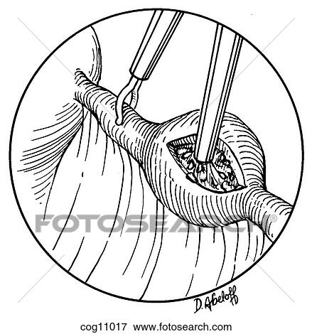 Ectopic pregnancy, resection, techn. 6, step 3 View Large Illustration Stock Illustration - Ectopic pregnancy, resection, techn. 6, step 3. Fotosearch