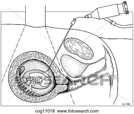 Stock Illustration - Embryofetoscopy, transabdominal thin-gauge. Fotosearch