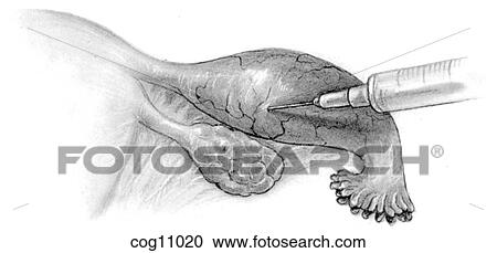 Clipart - Fallopian tube, infiltration. Fotosearch
