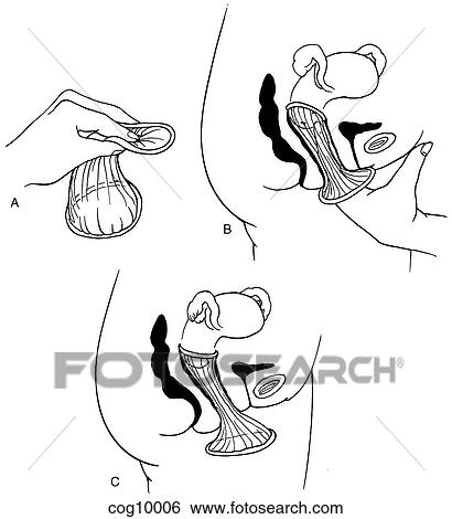 Female condom View Large Illustration Stock Illustration - Female condom. Fotosearch