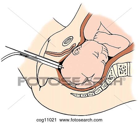 Fetal scalp blood sampling View Large Illustration Clip Art - Fetal scalp blood sampling. Fotosearch