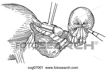 Clip Art - Fimbrioplasty. Fotosearch