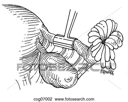 Drawing - Fimbrioplasty. Fotosearch