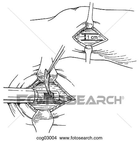 Harvesting fascia lata, step 2 View Large Illustration Stock Illustration - Harvesting fascia lata, step 2. Fotosearch