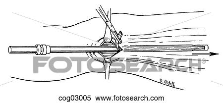 Stock Illustration - Harvesting fascia lata, step 3. Fotosearch