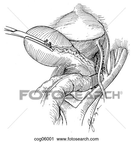 Hysterectomy, radical View Large Illustration Clip Art - Hysterectomy, radical. Fotosearch
