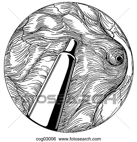 Stock Illustration - Hysteroscopy. Fotosearch