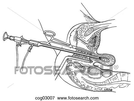 Stock Illustration - Hysteroscopy. Fotosearch