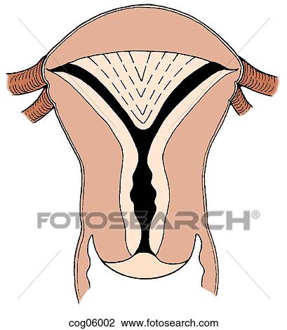 Drawing - Hysteroscopy uteroplasty. Fotosearch