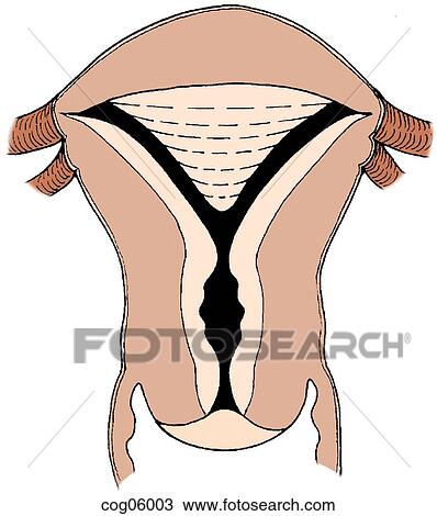 Drawing - Hysteroscopy uteroplasty. Fotosearch