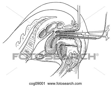 Clip Art - In-Vitro assisted reproduction. Fotosearch