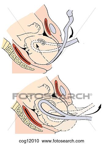 Clipart - Instrumental delivery, cephalic forceps. Fotosearch