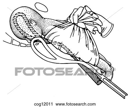 Clip Art - Instrumental delivery, forceps, breech. Fotosearch