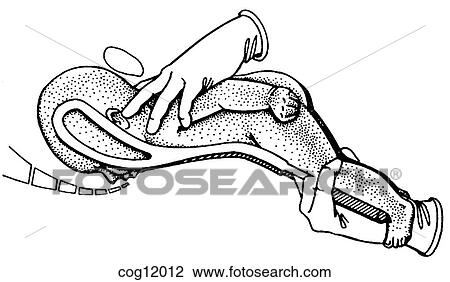 Instrumental delivery, forceps, breech View Large Illustration Drawing - Instrumental delivery, forceps, breech. Fotosearch