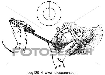 Instrumental delivery, forceps, step 2 View Large Illustration Stock Illustration - Instrumental delivery, forceps, step 2. Fotosearch