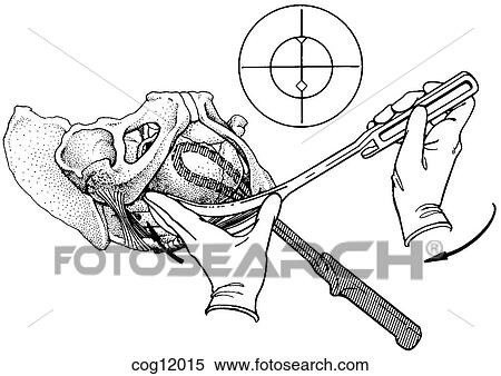 Stock Illustration - Instrumental delivery, forceps, step 3. Fotosearch