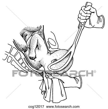 Instrumental delivery, forceps, step 5 View Large Illustration Stock Illustration - Instrumental delivery, forceps, step 5. Fotosearch