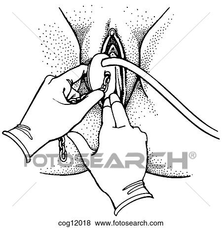 Instrumental delivery, outlet vacuum View Large Illustration Stock Illustration - Instrumental delivery, outlet vacuum. Fotosearch