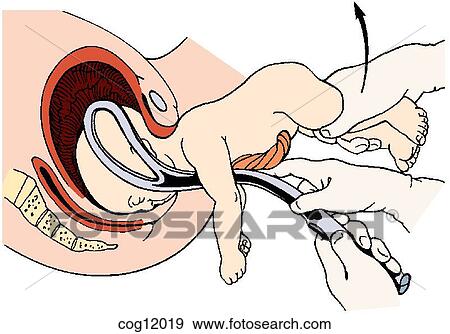 Stock Illustration - Instrumental delivery, Piper forceps. Fotosearch