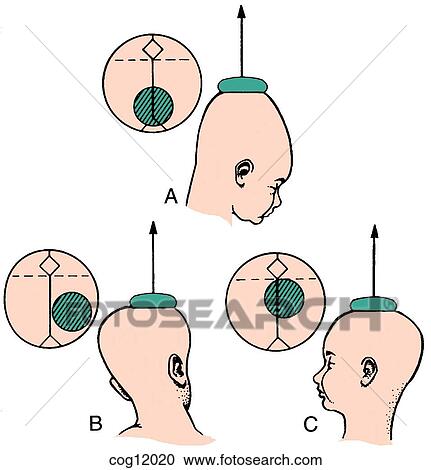 Instrumental delivery, vacuum cup View Large Illustration Clipart - Instrumental delivery, vacuum cup. Fotosearch