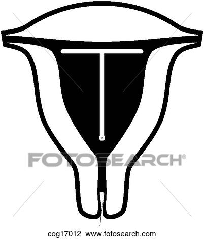 Intrauterine Device (IUD) View Large Illustration Drawing - Intrauterine Device (IUD). Fotosearch