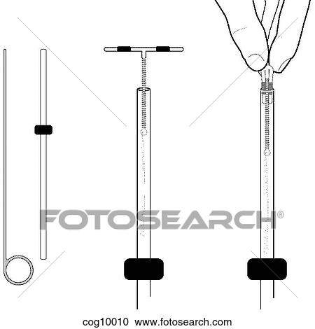 Intrauterine Devices, insertion, step 1 View Large Illustration Clipart - Intrauterine Devices, insertion, step 1. Fotosearch